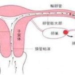 输卵管炎症状,识别与预防关键”